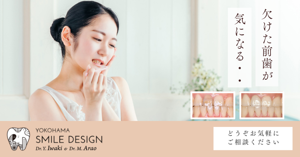 ダイレクトボンディング治療｜前歯の欠け・すきっ歯・変色の修復 Yokohama Smile Design