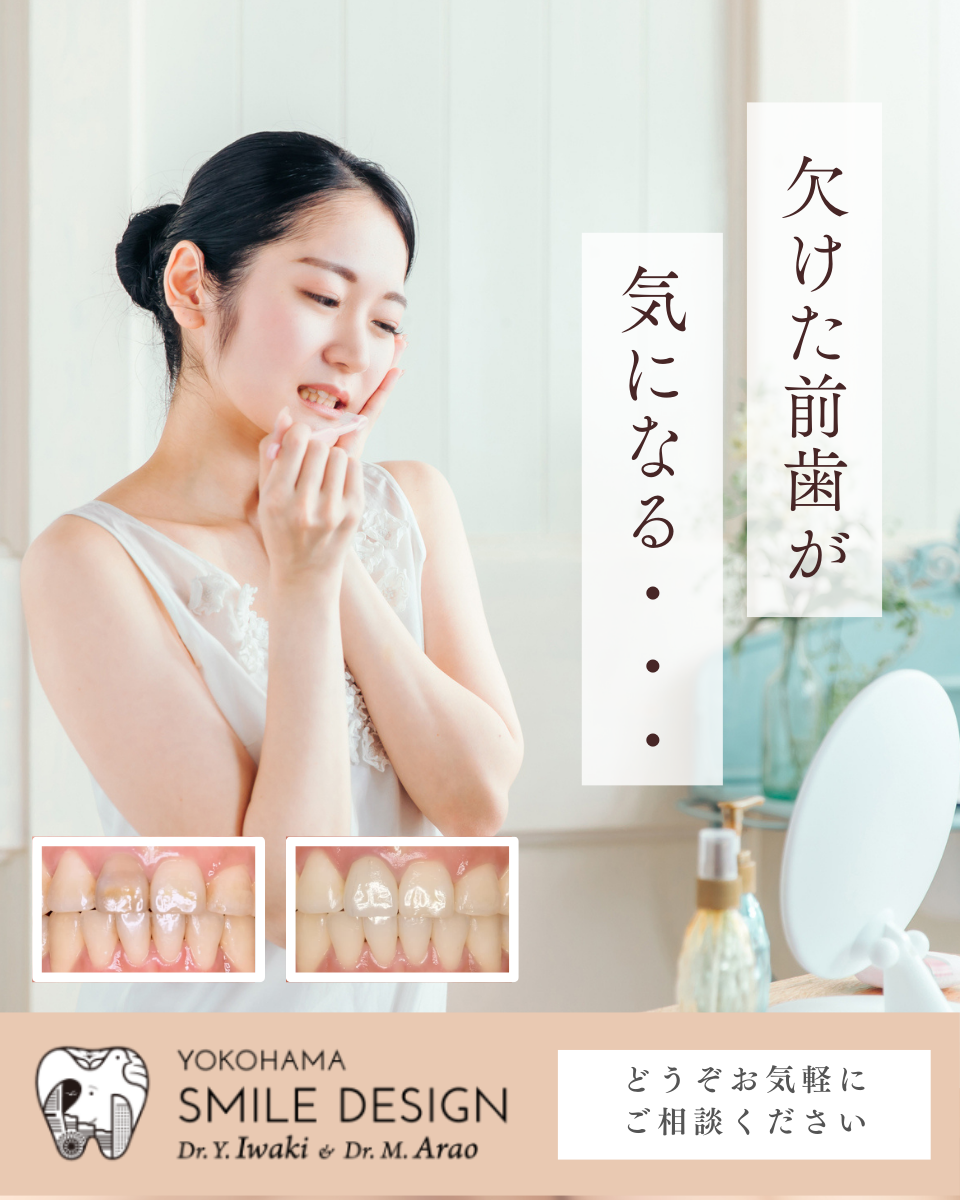 ダイレクトボンディング治療｜前歯の欠け・すきっ歯・変色の修復 Yokohama Smile Design